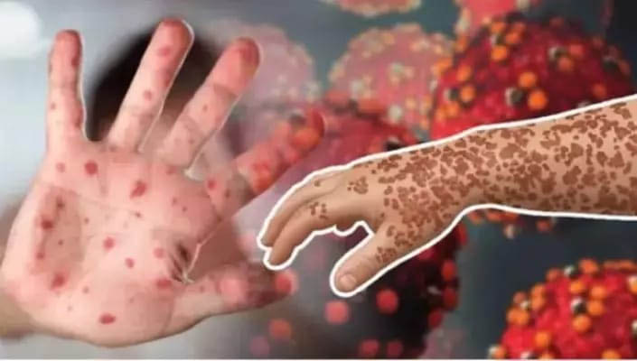 হামের উপসর্গ নিয়ে আরও ৫ শিশুর মৃত্যু